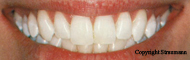 Blanchiment des dents